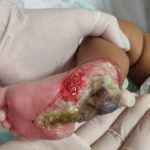 FAMÍLIA ACUSA ERRO MÉDICO NO HOSPITAL MATERNO-INFANTIL E BEBÊ PODE TER O PÉ AMPUTADO